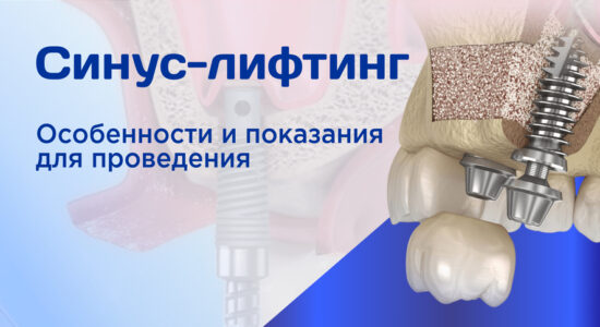 Обложка для статьи Синус-лифтинг